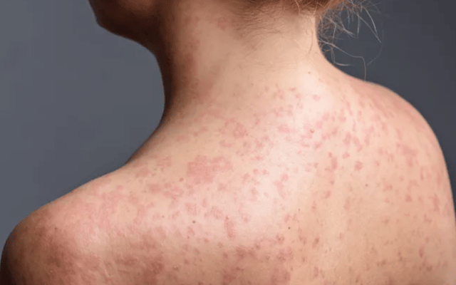 Measles is being reported in at least seven London boroughs 